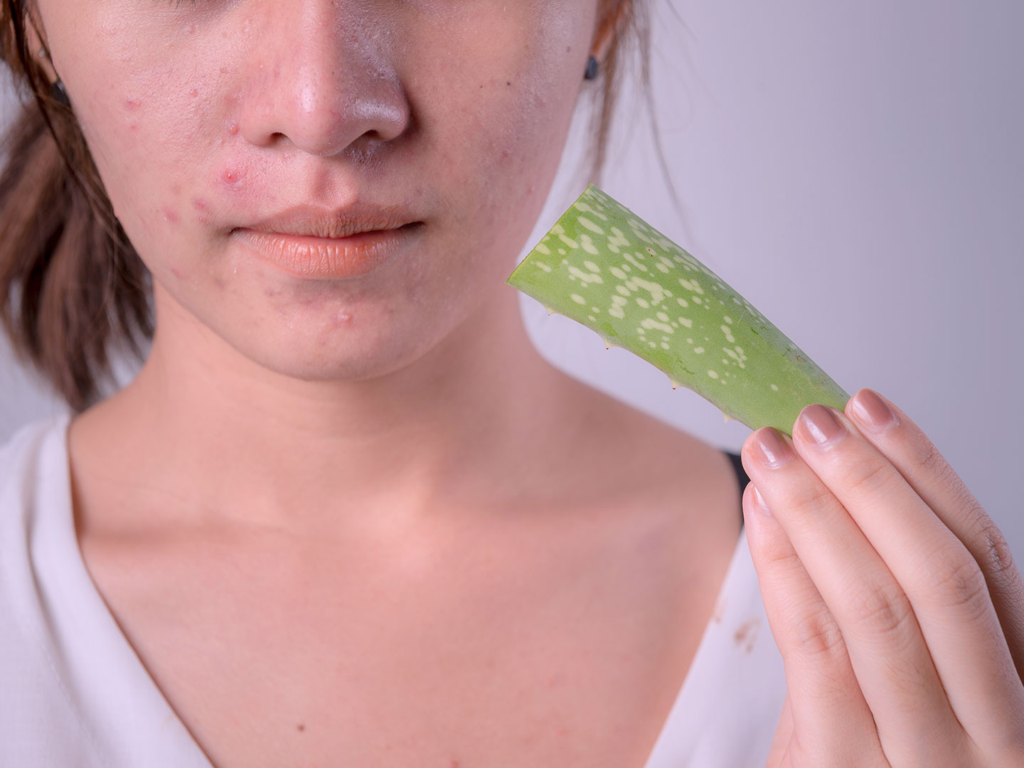 gel aloe vera per brufoli