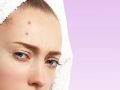 How to Treat and Prevent Pimples on Forehead