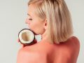 Can You Use Coconut Oil for Sunburns?