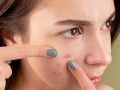 Causes and Solutions for Acne